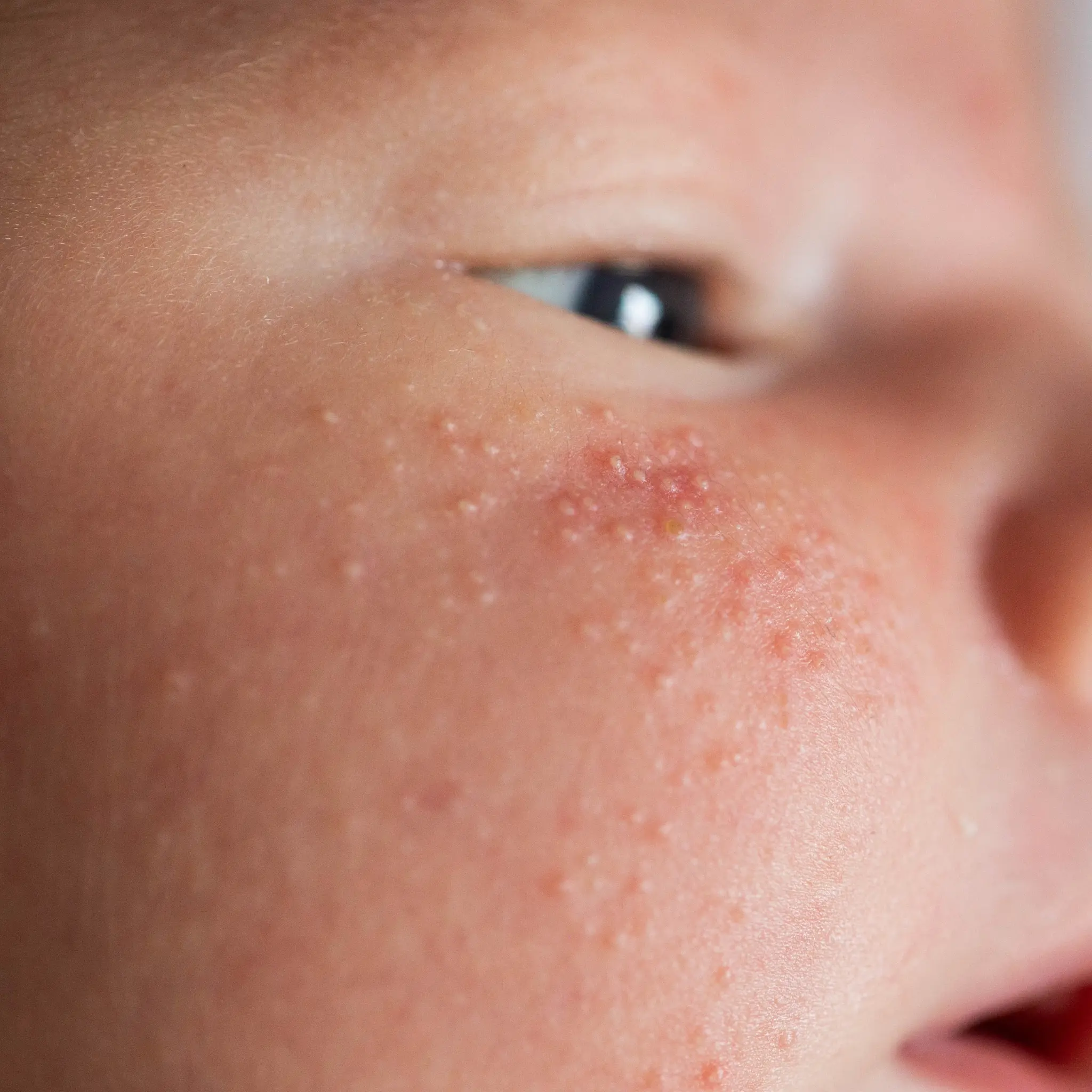 Sarpullido por calor en bebés: tratamientos y prevención | Minenito